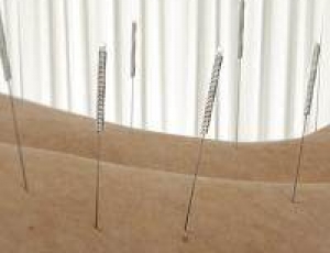 針灸減肥的優勢大盤點